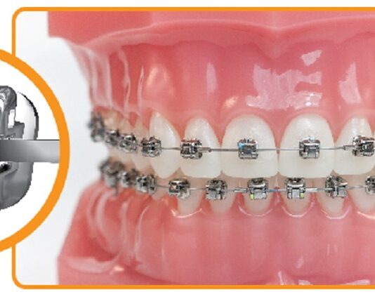 Aparatele dentare și gingivoplastia la clinica dentară DentoCare